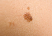 brown spots on skin