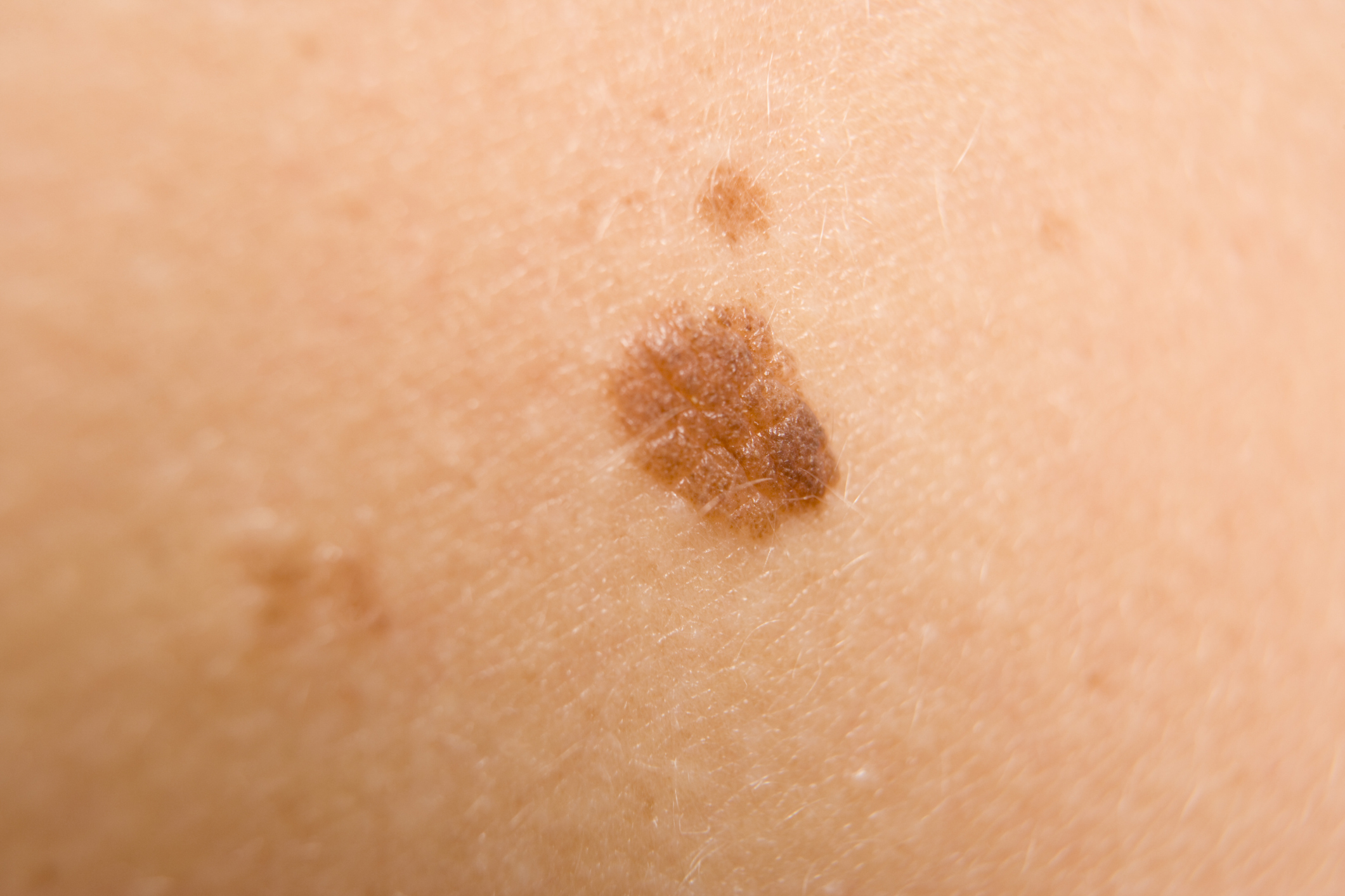 should-you-worry-about-that-mole-here-s-how-to-tell