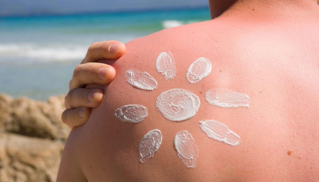 home remedies for sunburn