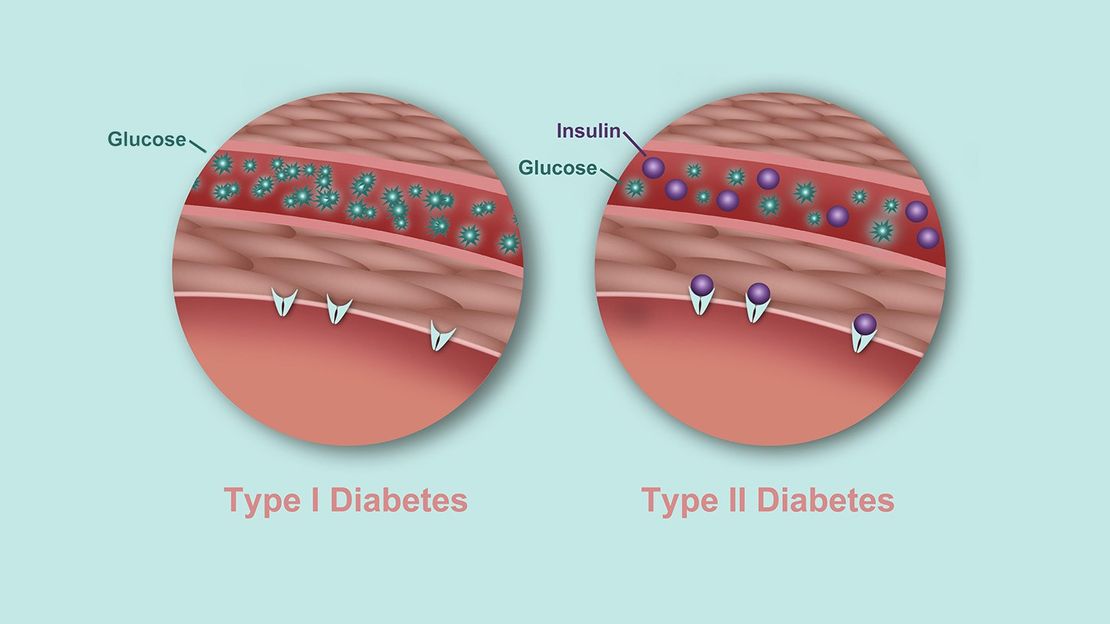 Is Pre Diabetes Type 1 Or 2