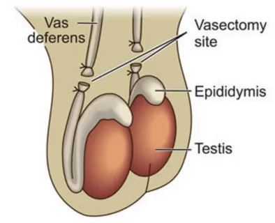 Vasectomy